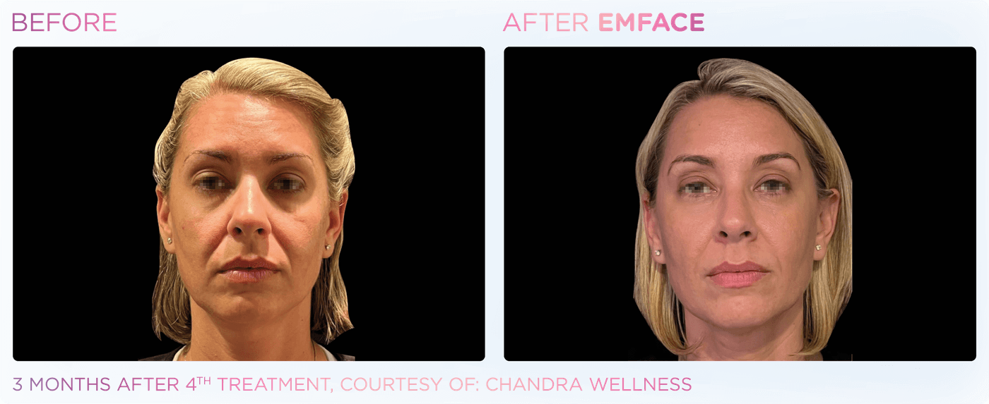 EMFACE