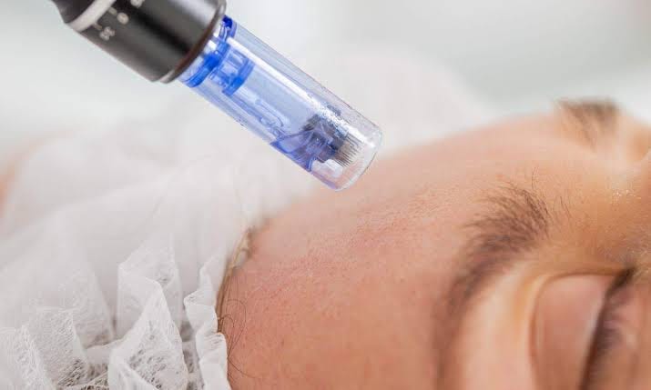 Dermal Pen Microneedling