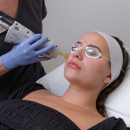 Facial Hair Removal Laser