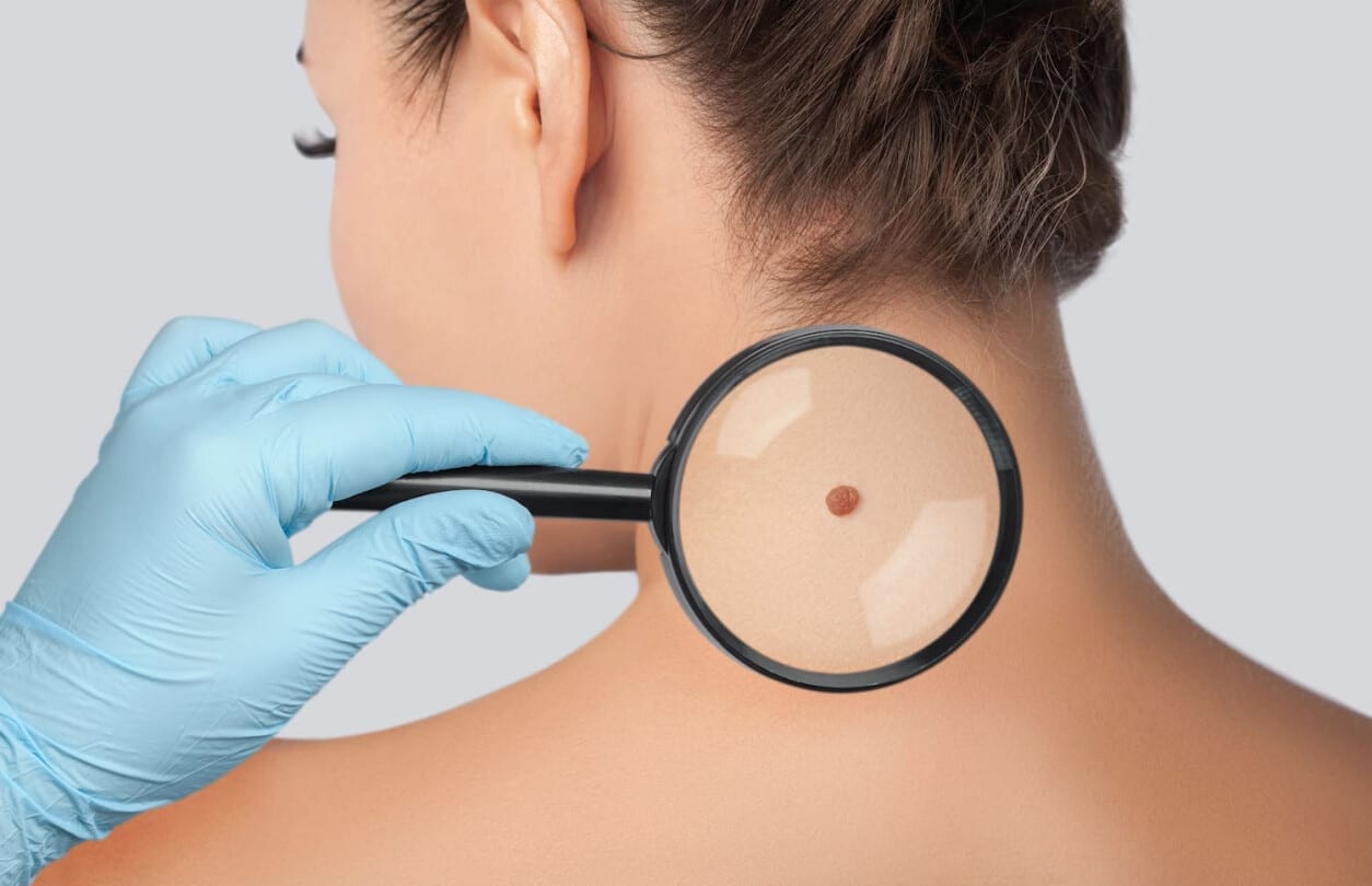 Mole, wart & skin tag removal