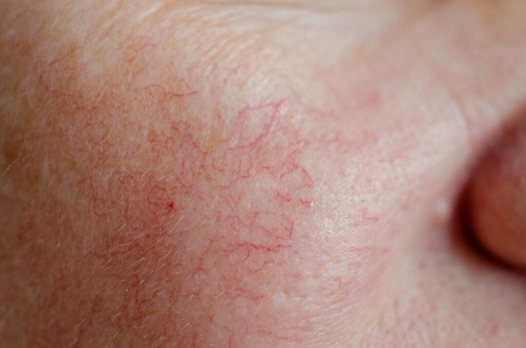 Thread Vein Removal
